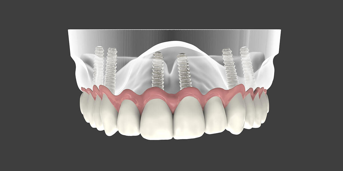 Dental Implant Supported Dentures in East Longmeadow