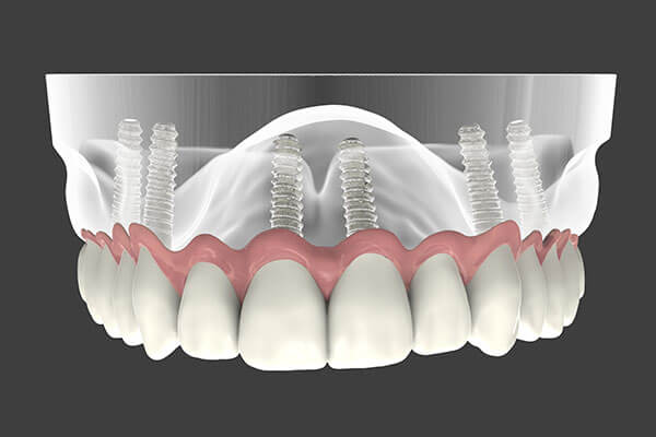 Implant Supported Dentures in East Longmeadow, MA