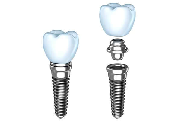 Single Dental implants in East Longmeadow, MA