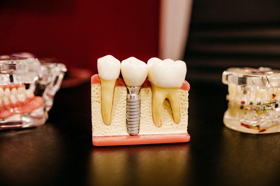 Dental Implants Process: Step By Step