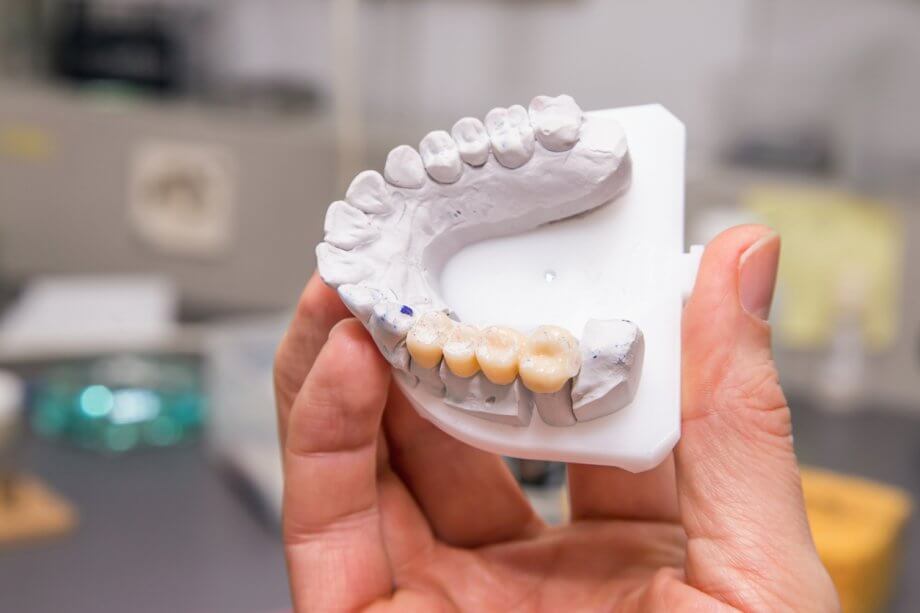 Technical Shot of Model Dental Bridge