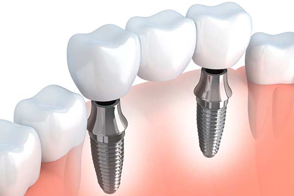 Dental Implant Supported Bridges in East Longmeadow