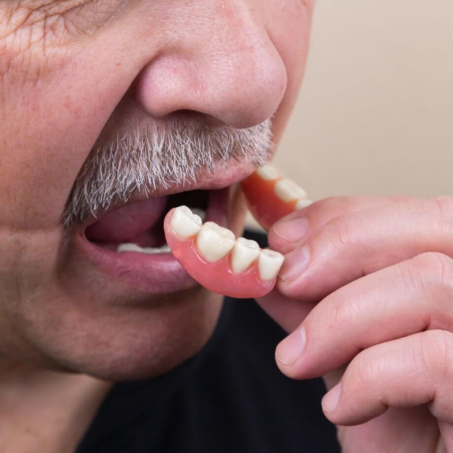 man putting in partial denture