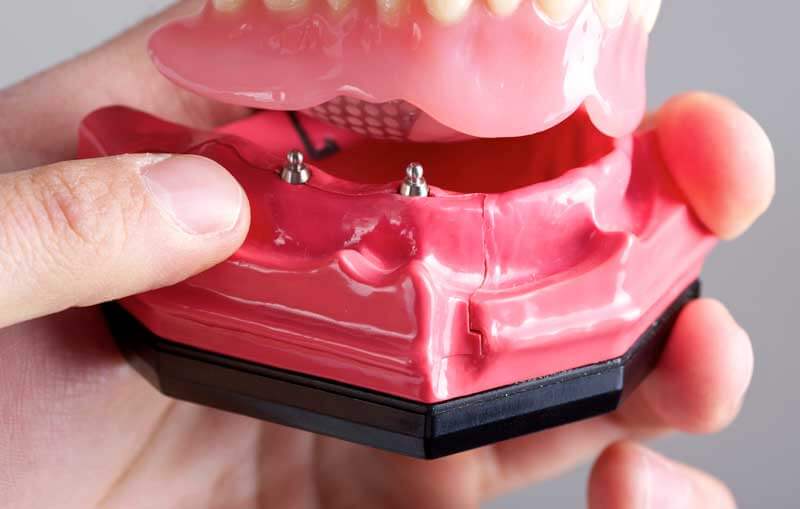 Mini Dental Implants in in East Longmeadow, MA