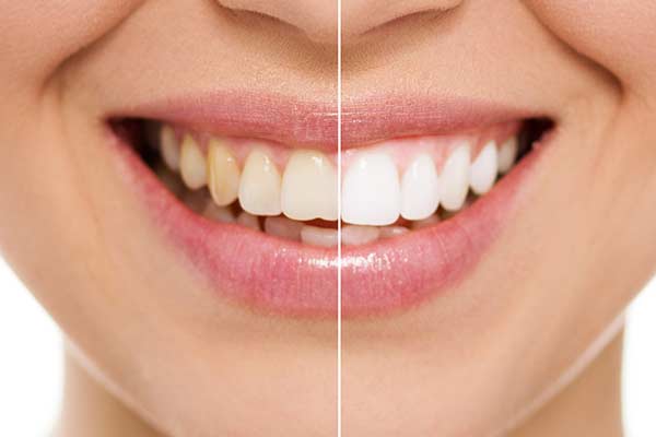 Before & After Teeth Whitening in East Longmeadow, MA