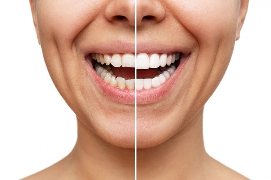 veneers before and after