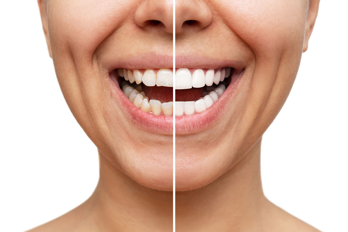 When Should You Get Veneers? When Should You Get Veneers?